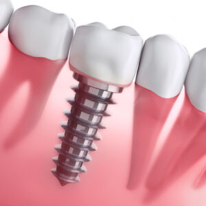 cosmetic dentistry in fuquay-varina