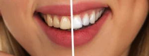 teeth whitening fuquay varina